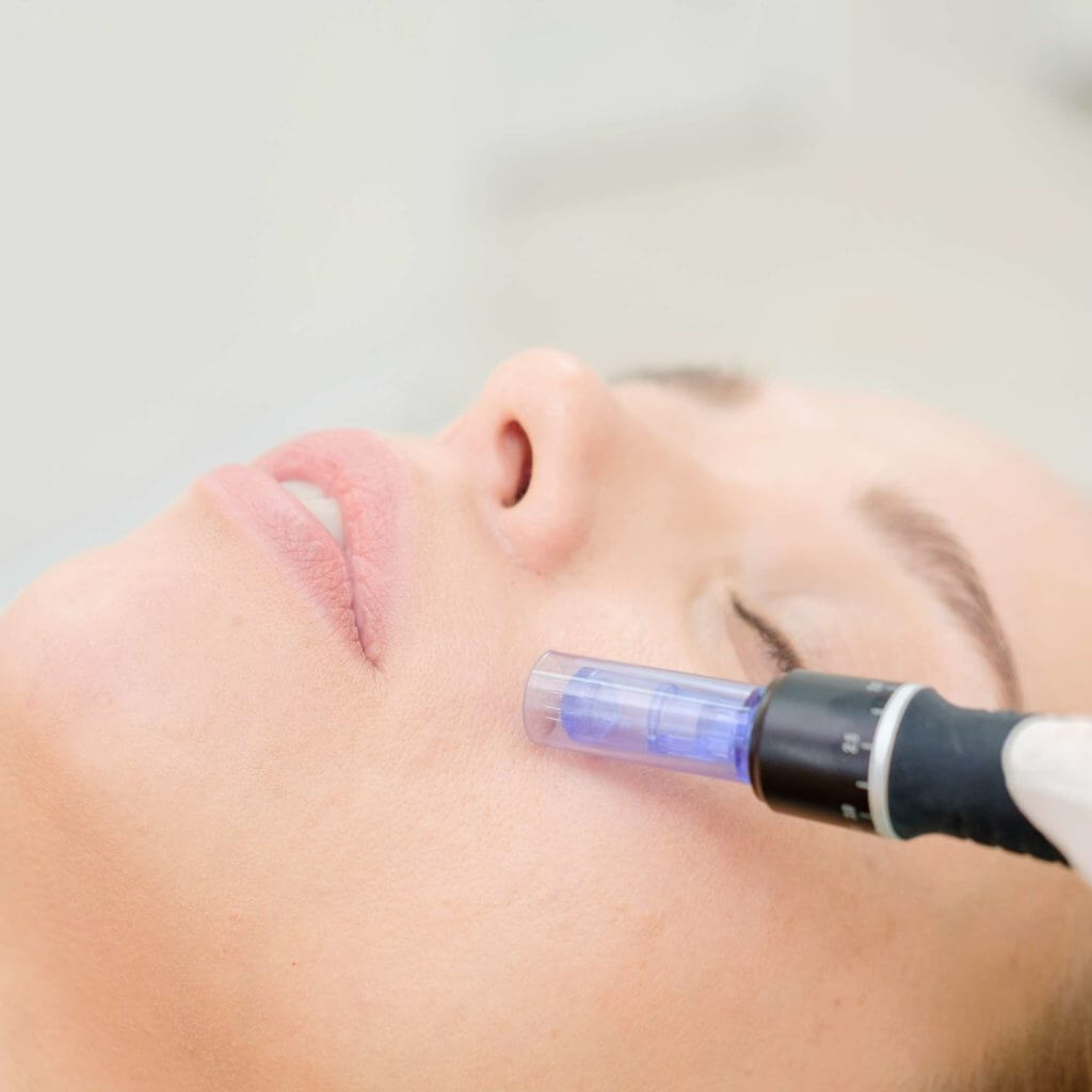 Microneedling Treatment in Newport Beach, CA | The Aesthetic Retreat